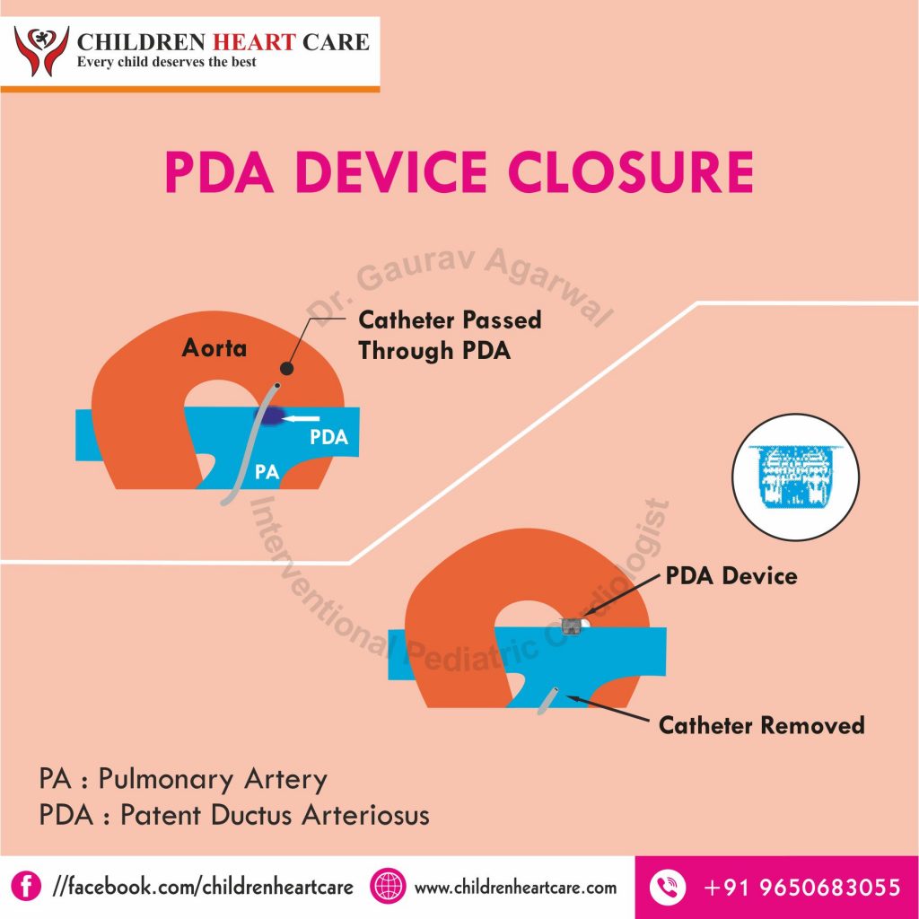 PDA DEVICE CLOSURE