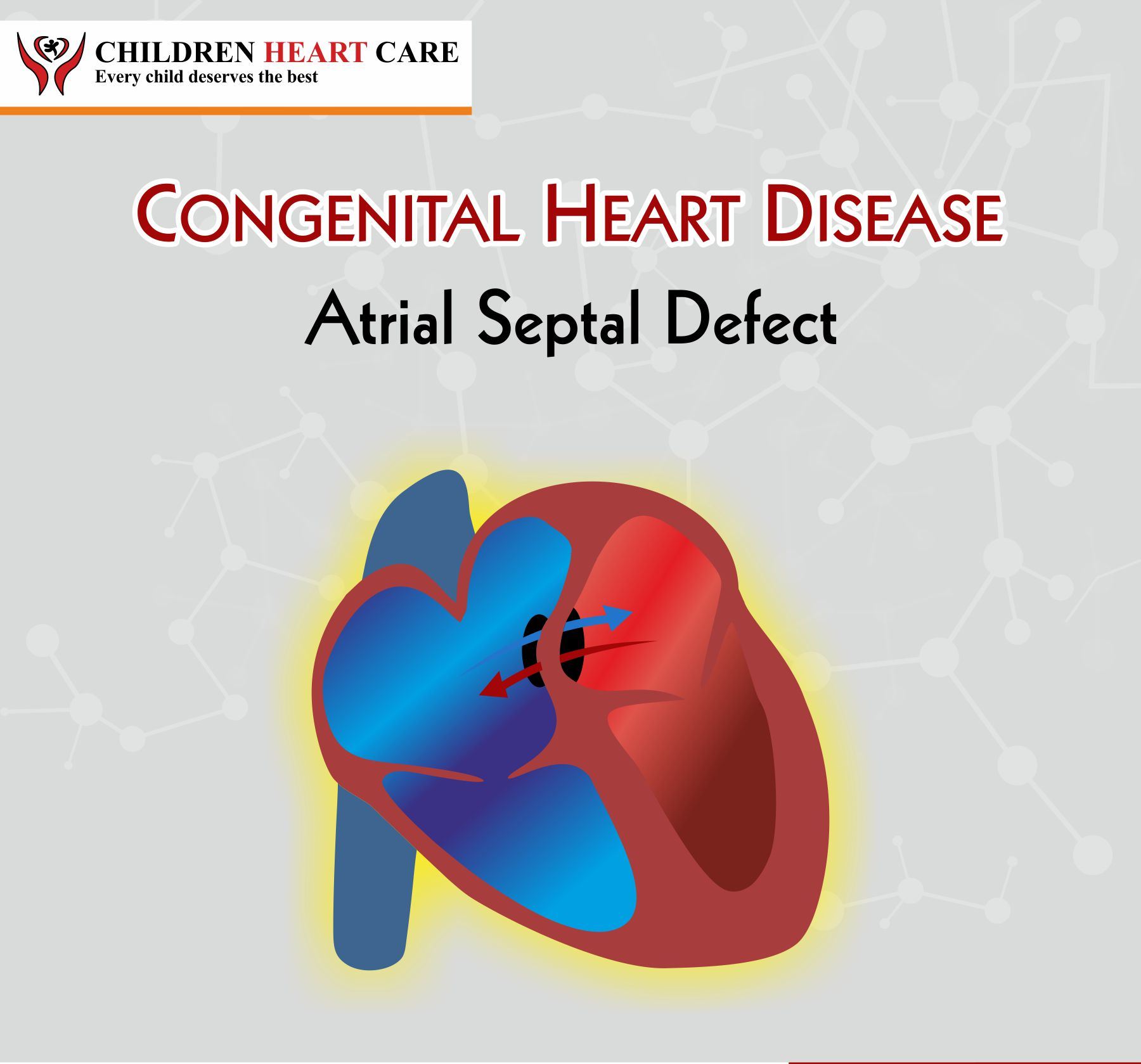 Atrial Septal Defect (ASD)