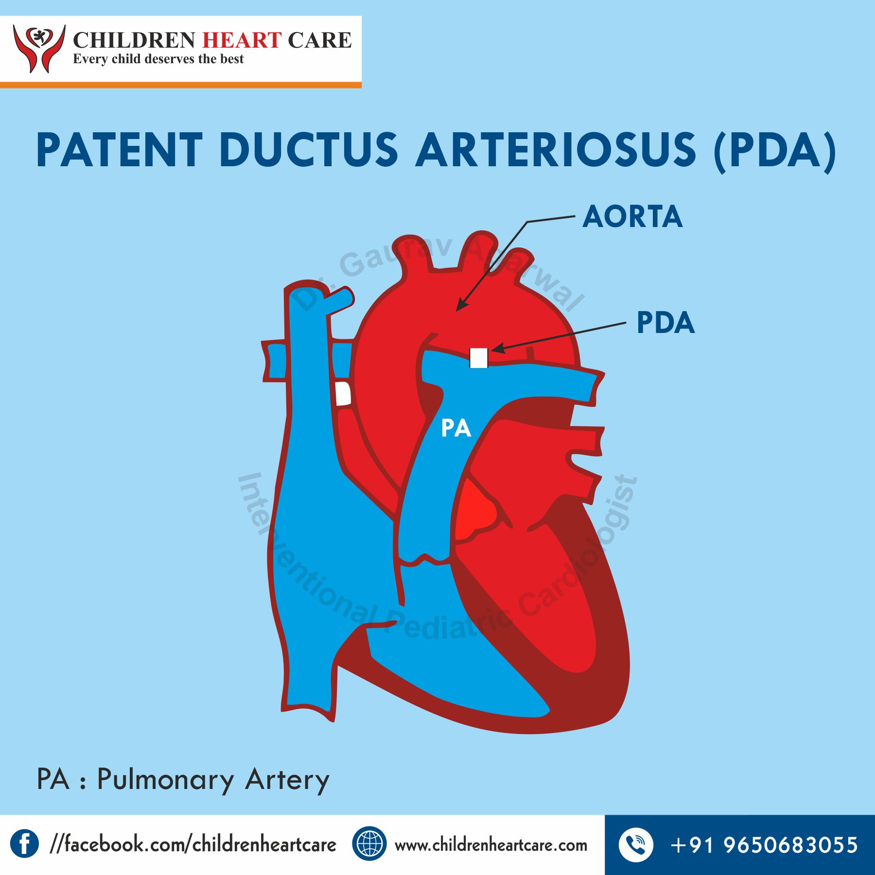 Patent Ductus Arteriosus (PDA) in Children