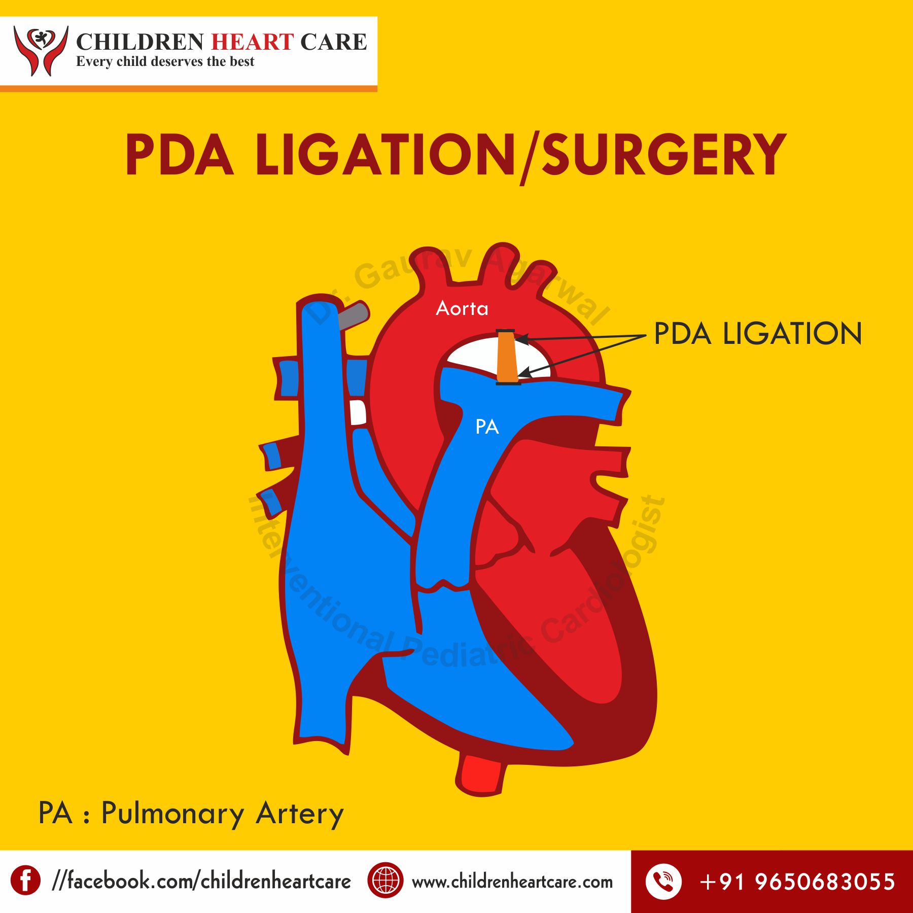 Treatment of Patent Ductus Arteriosus (PDA)