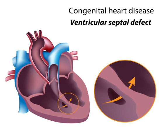 Ventricular Septal Defect (VSD) — Overview